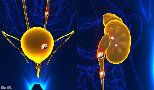 得结石不仅仅因为喝水少！高糖高脂、过量吃肉、过度素食都是原因