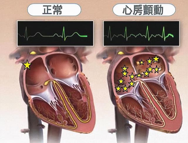 房颤治疗，首选导管消融