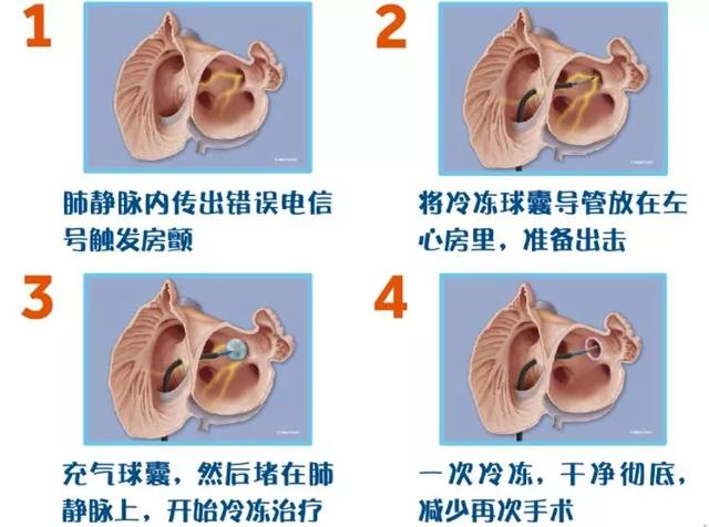 房颤治疗新手段—冷冻球囊消融术