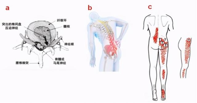 得了腰椎间盘突出症怎么办？可以保守治疗吗？一起来了解→