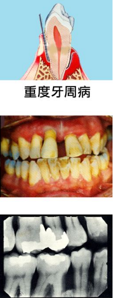 牙龈萎缩，该如何挽救？医生：200元的问题拖到10000+，呵呵