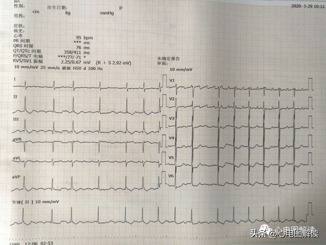 典型心房扑动