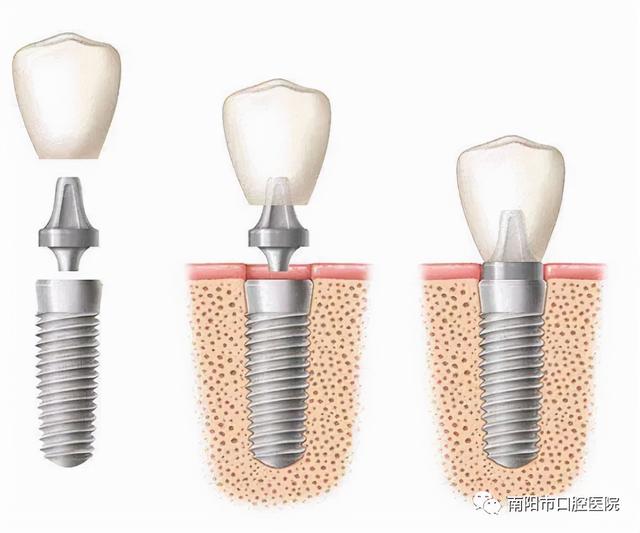 什么是种植牙、种牙过程疼吗