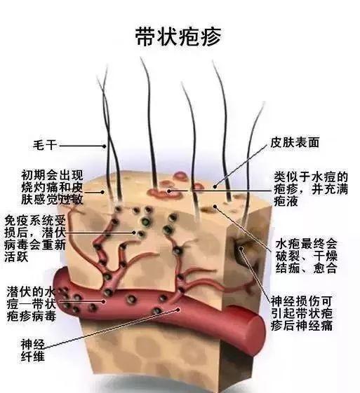 什么是带状疱疹，带状疱疹的治疗方法和措施