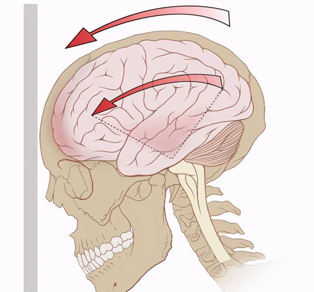 脑震荡到底是咋回事儿？这篇文章一次说清