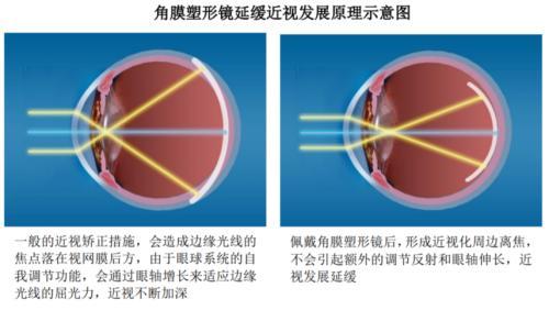 角膜塑形镜：近视预防主流路线背靠1.7亿近视患者衍生六百亿蓝海市场