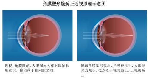 角膜塑形镜：近视预防主流路线背靠1.7亿近视患者衍生六百亿蓝海市场