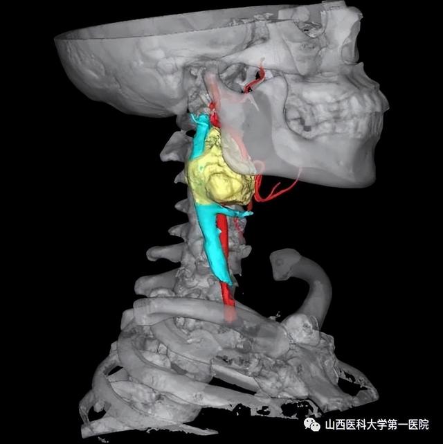 山西医科大学第一医院多学科联合成功完成一例III型颈动脉体瘤切除