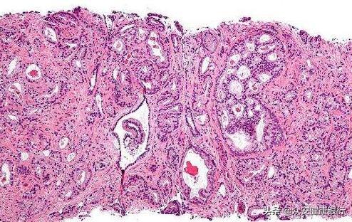 PeerJ：科学家鉴别出驱动前列腺癌发生转移的特殊生物标志物