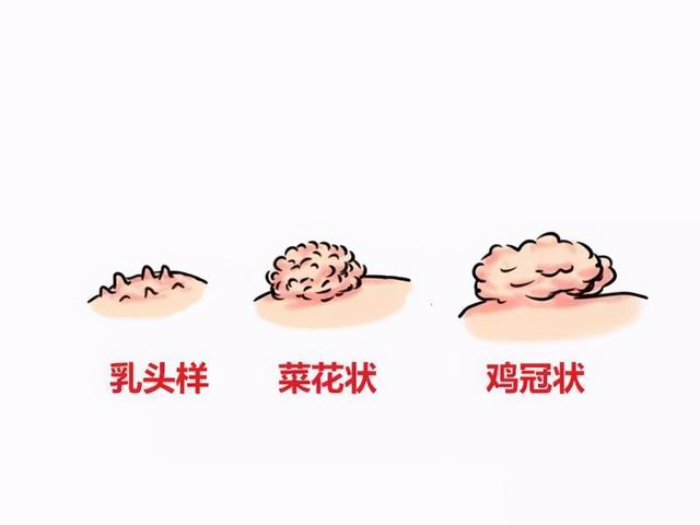 私处长痘痘一定是疣吗？别慌，还可能是这两种情况