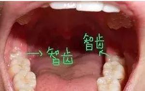 「荐读」智齿到底该不该拔？作为牙医我坦诚实情