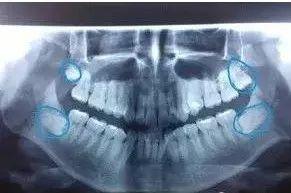 「荐读」智齿到底该不该拔？作为牙医我坦诚实情